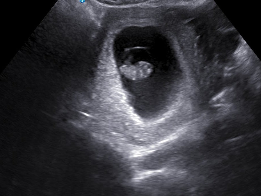 Gray Ultrasound Photo Album - My Baby's Heartbeat Bear